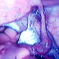 laparoscopy