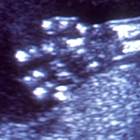 fetal scan