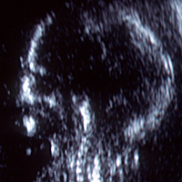 fetal head