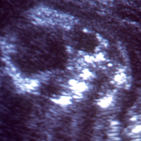 fetal scan